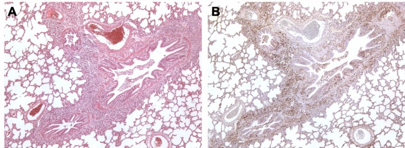 Figure 3. Pig lung co-infected by&nbsp;M. hyopneumoniae and PCV2. A: Area of peribronchiolar lymphoid hyperplasia caused by M. hyopneumoniae. B: Large amount of PCV2 antigen in this same area of lymphoid hyperplasia.
